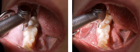 Comparación: LED y W&H con LED+