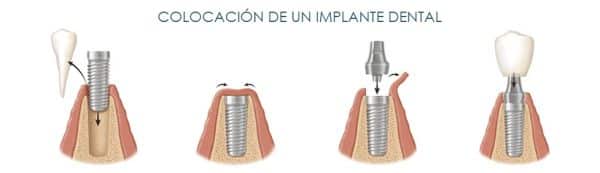 colocacion-implante-dental